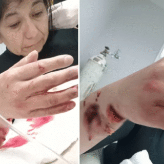 RÍO GALLEGOS: Un pitbull atacó a una runner en la costanera y terminó en el quirófano: “Le destrozó el brazo”