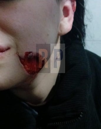 Está detenido el sujeto de Ushuaia que atacó a su ex pareja y la desfiguró arrancándole una parte de su mejilla de un mordisco