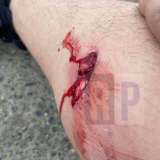 Grave ataque de un pitbull a un joven y denuncia contra los propietarios