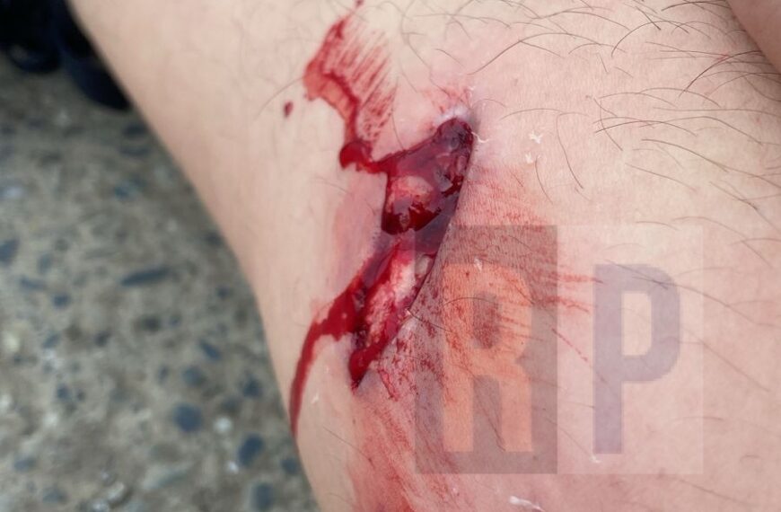 Grave ataque de un pitbull a un joven y denuncia contra los propietarios